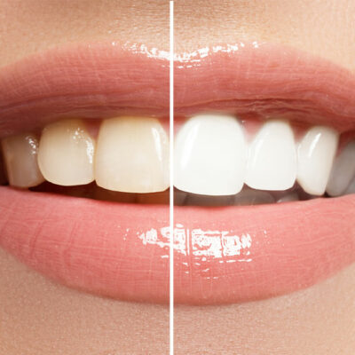4 Ways to Effectively Whiten Teeth at Home
