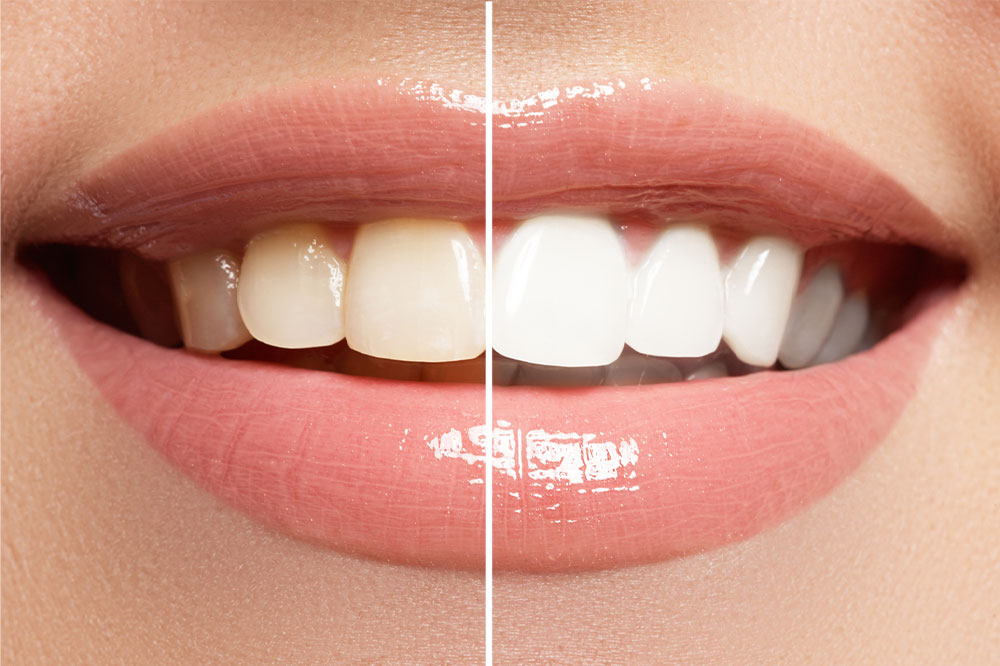 4 Ways to Effectively Whiten Teeth at Home